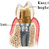 Mất răng, cần làm răng sứ hãy đến tư vấn cấy ghép răng Implant nha khoa