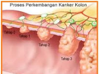 MEMBEDAKAN TUMOR GANAS DAN JINAK