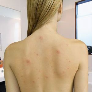 acne treatment on the back