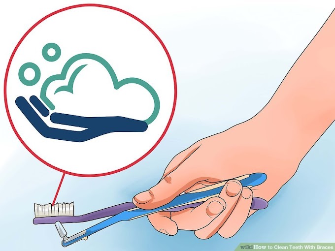 How to Clean Teeth With Braces