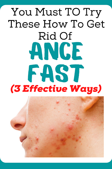 HOW TO GET RID OF ACNE FAST (3 EFFECTIVE WAYS)