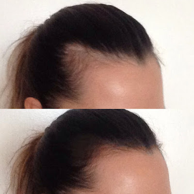 hair loss after birth