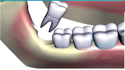 Điều trị răng khôn bị lợi trùm