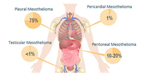Stage 1 Pleural Mesothelioma