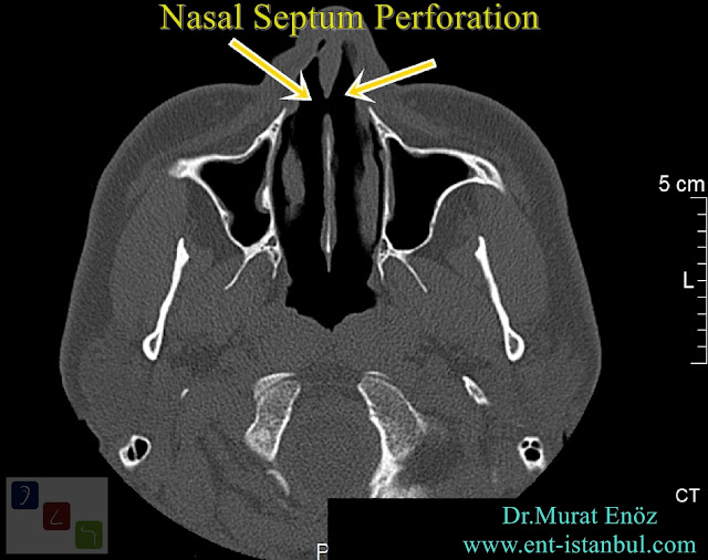 Nasal Septum Perforation Treatment