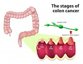THINGS YOU NEED TO KNOW ABOUT COLORECTAL CANCER 