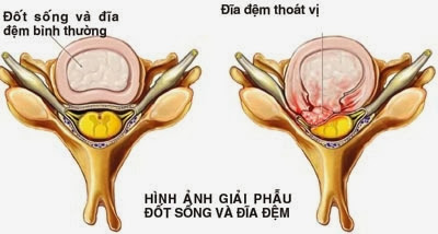 nguyên nhân thoát vị đĩa đệm