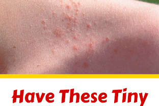 Have These Tiny Red Pimples on You Body? They Might Be Signs of This Serious Condition!