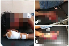 Dua Geng Bentrok di Dompu, Satu Anggota Geng Asal Rora Bima Terluka Parah Disambar Parang
