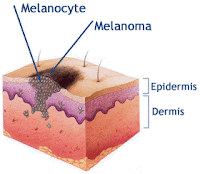 melanositte melanom