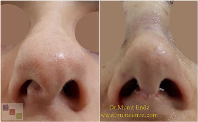 Twisted nose - Crooked nose surgery - Scoliotic nose - Crooked nose - Treatment of twisted nose  - Treatment of crooked nose - Challenges in treatment of deviated nose - Crooked nose aesthetic surgery in Istanbul - Twisted nose treatment in Istanbul - Rhinoplasty in Istanbul - Nose job in Istanbul