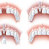 Trồng răng implant nhanh trong một ngày