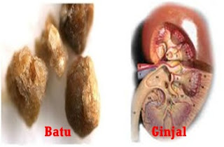 Obat batu ginjal pasca operasi