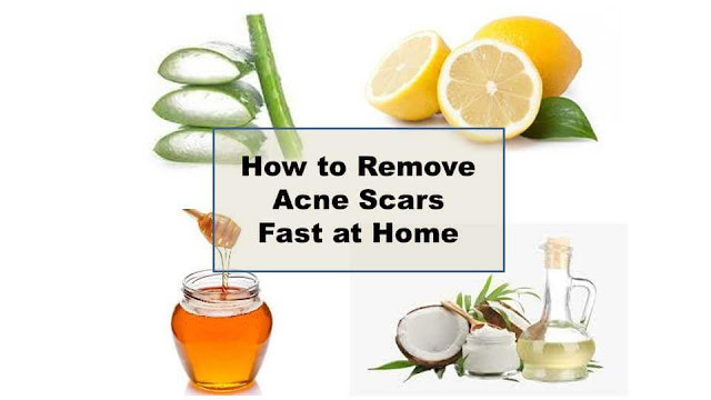 How to Remove Acne Scars Fast at Home with Top 6 Natural Remedies