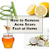 How to Remove Acne Scars Fast at Home with Top 6 Natural Remedies
