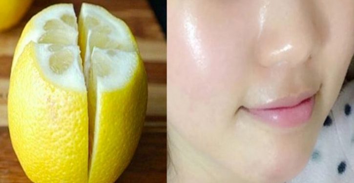 Use Lemon To Remove Stains From Your Face And Have Radiant Skin In Two Days