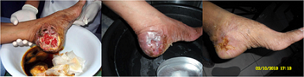 Quantumin Plus Infected Wound Healing
