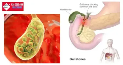 What are Gallstones?
