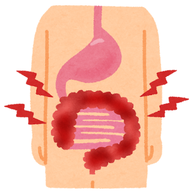 大腸炎のイラスト