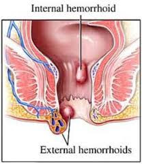 WASIR/AMBEIEN"pengertian,gejala,anjuran,obat dll