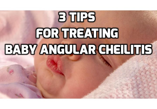 Angular Cheilitis is one of those skin conditions which can be quite harsh on babies. It usually appears in the corners of their mouths, as these areas are almost always wet, thus favoring the development and growth of fungi and bacteria. Here are the 3 tips you can use for treating baby angular cheilitis.
