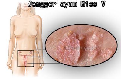 Obat Terbaik Jengger Ayam