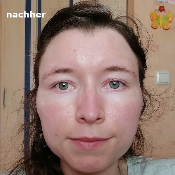 Haut nachher