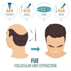 Hair transplant in Jaipur