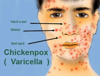 Cara Mengobati Cacar Air (Chickenpox)