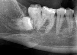 <Img src ="molar-retenido-afectando-raiz-del-molar-adyacente.jpg" width = "773" height "552" border = "0" alt = "Tercer molar en contacto con la raíz del segundo molar">