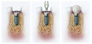 Dental Implants