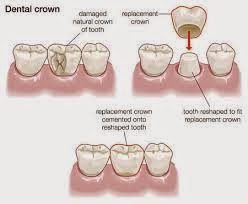 Low Cost Dental Crowns and Bridges in Delhi India