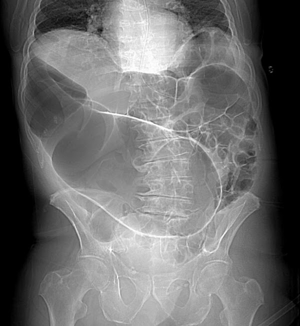 Abdominal plain x-ray shows sigmoid volvulus