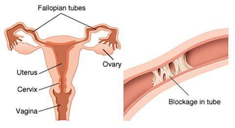 http://kasturihospitals.com/gynaecology/tubal-blockage-fallopian-tube-obstruction.html