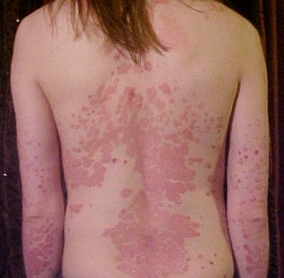  Psoriasis Treatment — The Best 2 Remedies For Psoriasis
