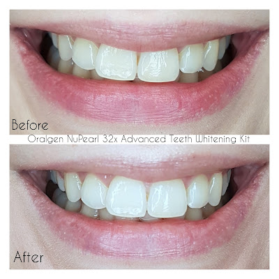 Oralgen NuPearl 32x Advanced Teeth Whitening Kit before and after