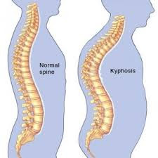 Bungkuk kedepan/kifosis? Ini tips untuk mengatasinya | widadaraharja.blogspot.com