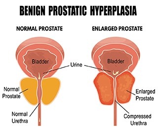 Enlarged prostate, Benign Prostatic  Hyperplasia, Prostate enlargement