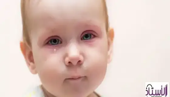 Inflammation-of-the-eyes-of-infants-symptoms-and-treatment