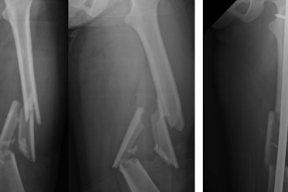 Radiographic Outcomes Of The Treatment Of Complex Femoral Shaft Fractures