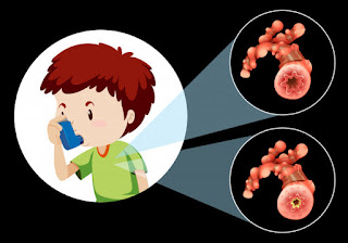 氣喘原因,小兒氣喘,什麼是氣喘,兒童氣喘,氣喘兒