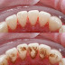 Các bước quy trình cạo vôi răng