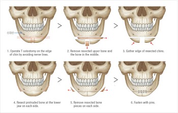 Phẫu thuật hàm hô móm