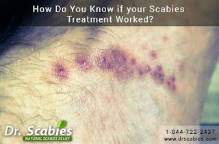 Scabies Treatmnet