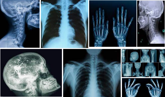 X Rays फुल फॉर्म