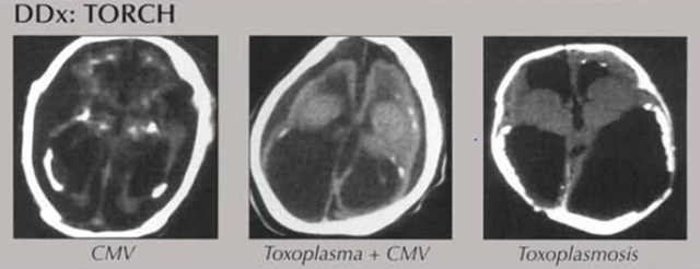 abnormal mri brain