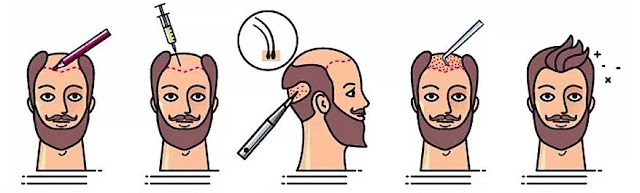 الخطوات الجراحية لزراعة الشعر | مراحل زراعة الشعر