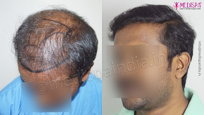 hair transplant in India