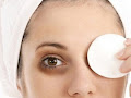 How To Get Rid Of Dark Circles Under Eyes Naturally