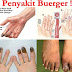 Obat Tradisional Penyakit Buerger